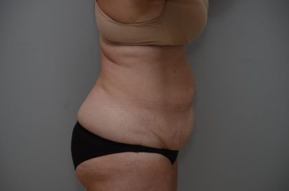 Abdominoplasty Before & After Patient #3186