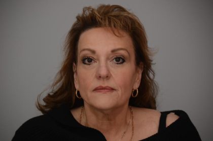 Facelift Before & After Patient #3187