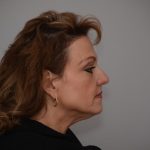 Facelift Before & After Patient #3187