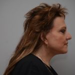 Facelift Before & After Patient #3187