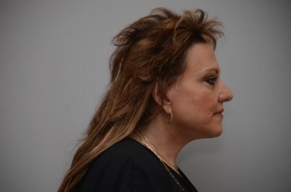 Facelift Before & After Patient #3187