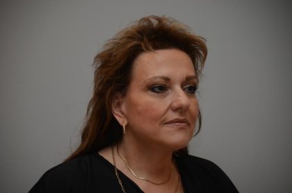 Facelift Before & After Patient #3187
