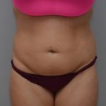 Abdominoplasty Before & After Patient #3188