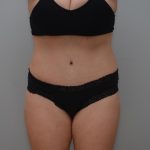 Abdominoplasty Before & After Patient #3188