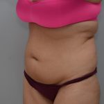 Abdominoplasty Before & After Patient #3188