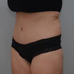 Abdominoplasty Before & After Patient #3188