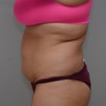 Abdominoplasty Before & After Patient #3188