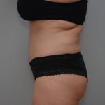 Abdominoplasty Before & After Patient #3188