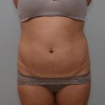 Abdominoplasty Before & After Patient #3190