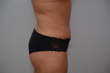 Abdominoplasty Before & After Patient #3190