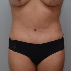 Abdominoplasty Before & After Patient #3190