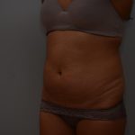 Abdominoplasty Before & After Patient #3190