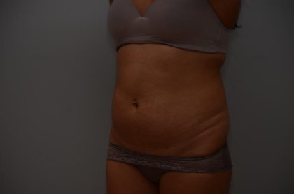 Abdominoplasty Before & After Patient #3190