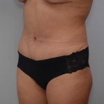Abdominoplasty Before & After Patient #3190