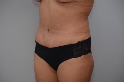 Abdominoplasty Before & After Patient #3190