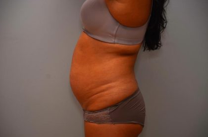 Abdominoplasty Before & After Patient #3190