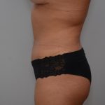 Abdominoplasty Before & After Patient #3190