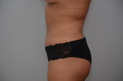 Abdominoplasty Before & After Patient #3190