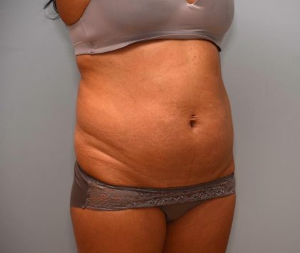 Abdominoplasty Before & After Patient #3190