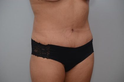 Abdominoplasty Before & After Patient #3190