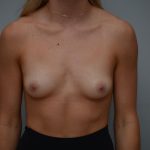 Breast Augmentation Before & After Patient #3191