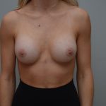 Breast Augmentation Before & After Patient #3191