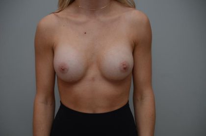 Breast Augmentation Before & After Patient #3191