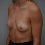 Breast Augmentation Before & After Patient #3191