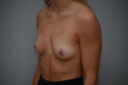 Breast Augmentation Before & After Patient #3191