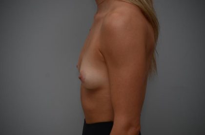 Breast Augmentation Before & After Patient #3191