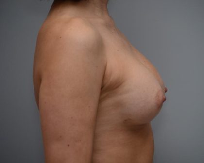 Breast Augmentation Before & After Patient #3192