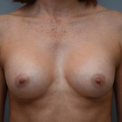 Breast Augmentation Before & After Patient #3192