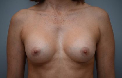 Breast Augmentation Before & After Patient #3192