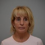 Facelift Before & After Patient #3193