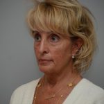 Facelift Before & After Patient #3193