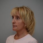 Facelift Before & After Patient #3193