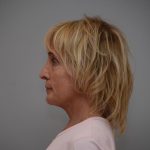 Facelift Before & After Patient #3193