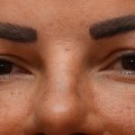 Blepharoplasty Before & After Patient #3194