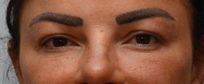 Blepharoplasty Before & After Patient #3194