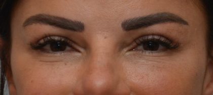 Blepharoplasty Before & After Patient #3194
