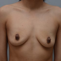 Breast Augmentation Before & After Patient #3400