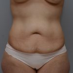 Abdominoplasty Before & After Patient #3443
