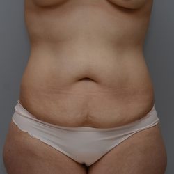 Abdominoplasty Before & After Patient #3443