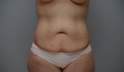 Abdominoplasty Before & After Patient #3443