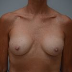 Breast Implant Exchange Before & After Patient #3455
