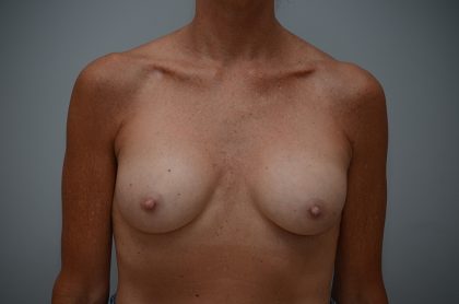 Breast Implant Exchange Before & After Patient #3455