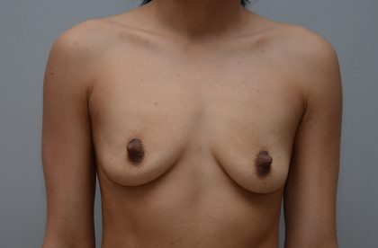 Breast Augmentation Before & After Patient #3400