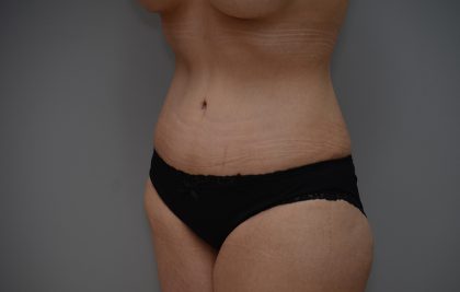 Abdominoplasty Before & After Patient #3443