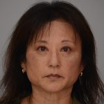 Blepharoplasty Before & After Patient #3421