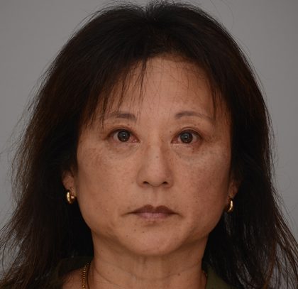 Blepharoplasty Before & After Patient #3421